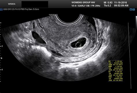5 2. . 12 mm gestational sac how many weeks